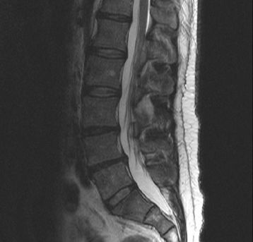 Picture of a spine showing symptoms of sciatica